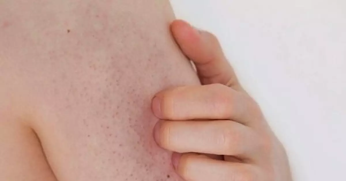 秋冬皮膚乾燥起粒粒？3大錯誤加劇毛囊角化