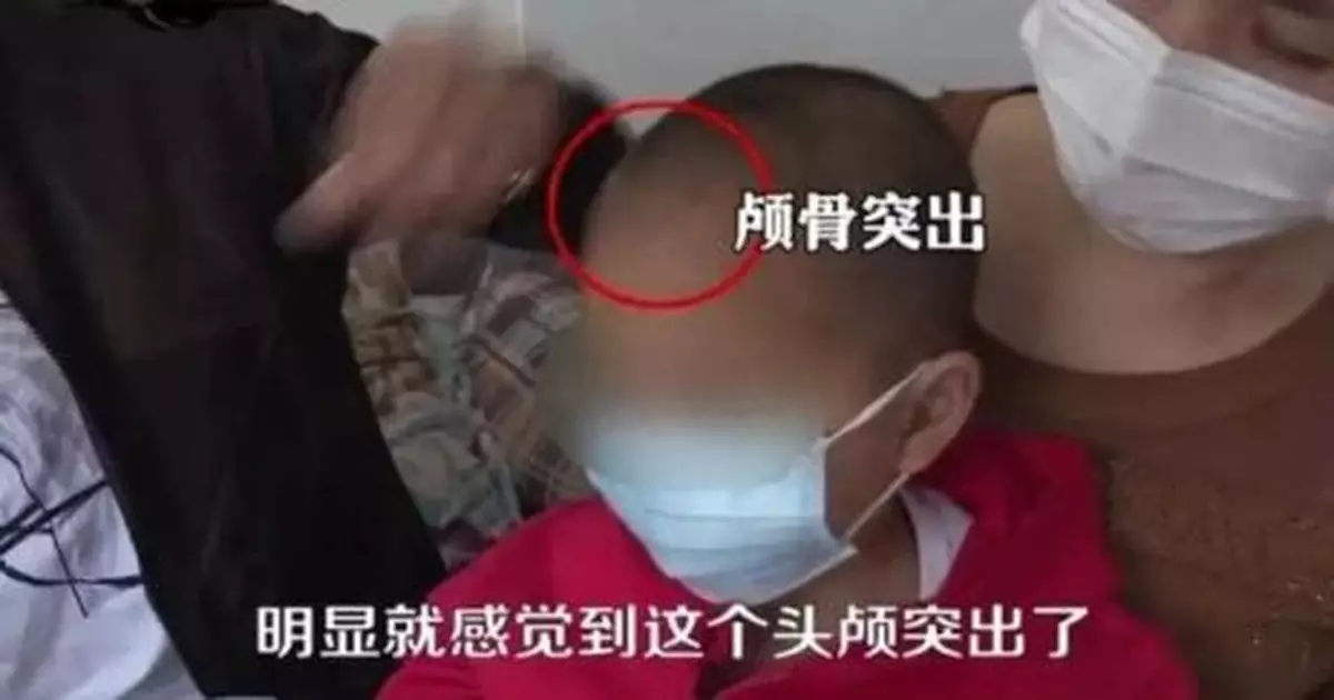 「大頭娃娃」家長:孩子喝89罐 從會說話起喉嚨就沙啞