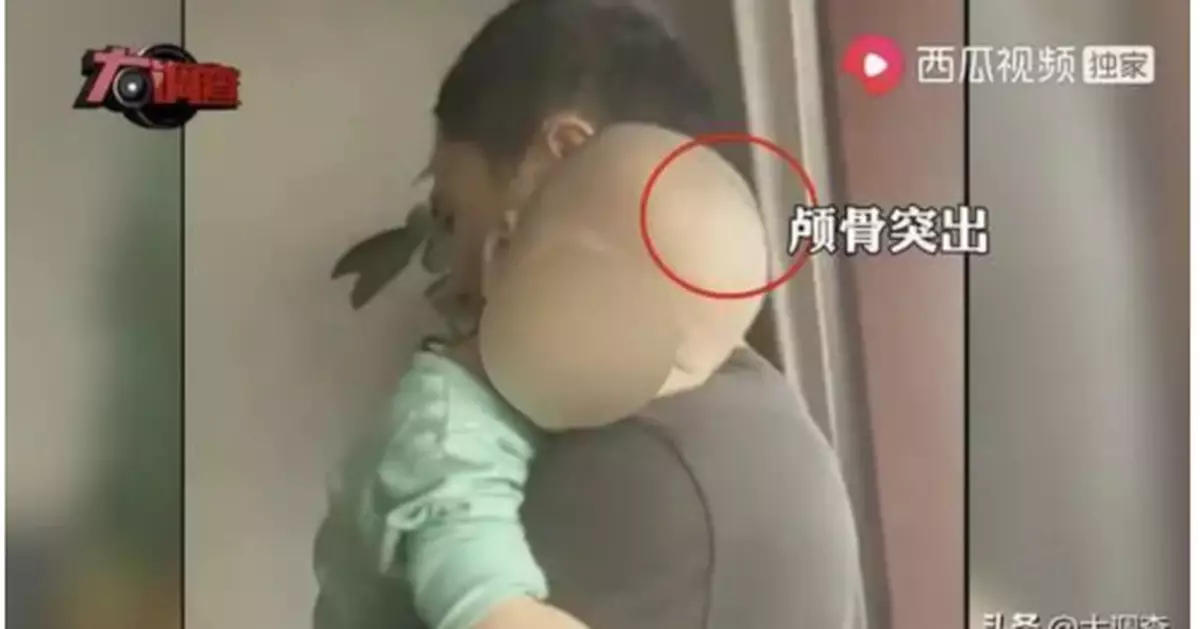 郴州再現「大頭娃娃」 疑固體飲料冒特醫奶粉 調查啟動