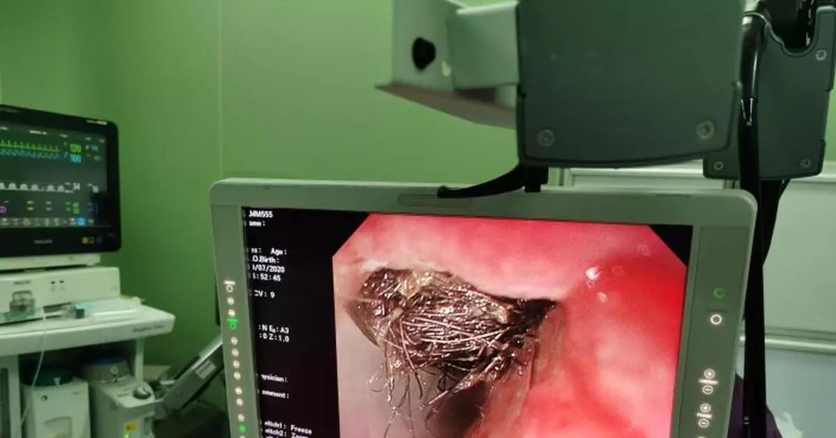 9歲女孩嘔吐數日送入急診 醫生驚呆：胃裏竟全是頭髮