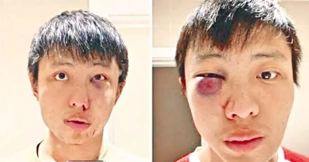 遭歧視「播毒」 星少年在英捱毆