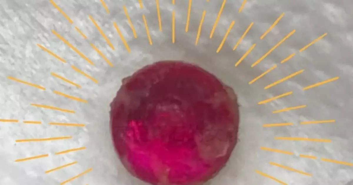 台女童耳朵散發亮光 醫生取出發現竟是「紅寶石」