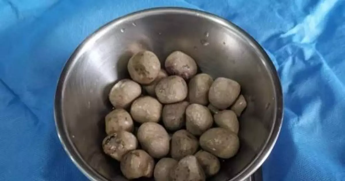 老人體內取出半斤結石 專家：前列腺癌需早治