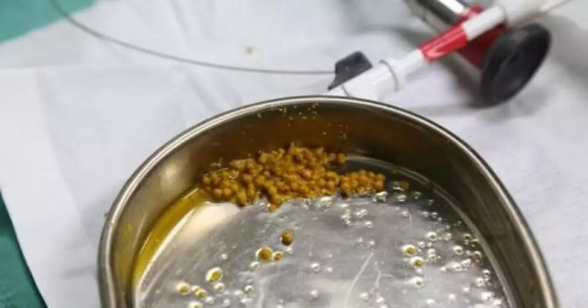 成都某醫院收治多名低齡膽結石患者 專家：生活飲食習慣不當導致