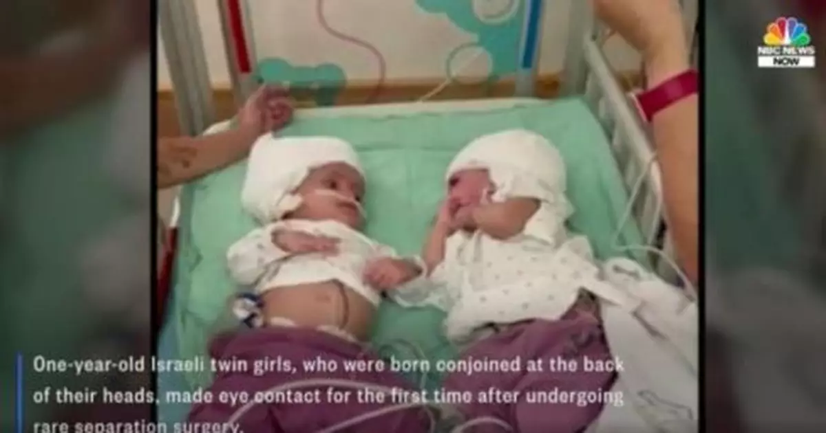 1歲頭部相連雙胞胎成功手術分開 出生後首次對視