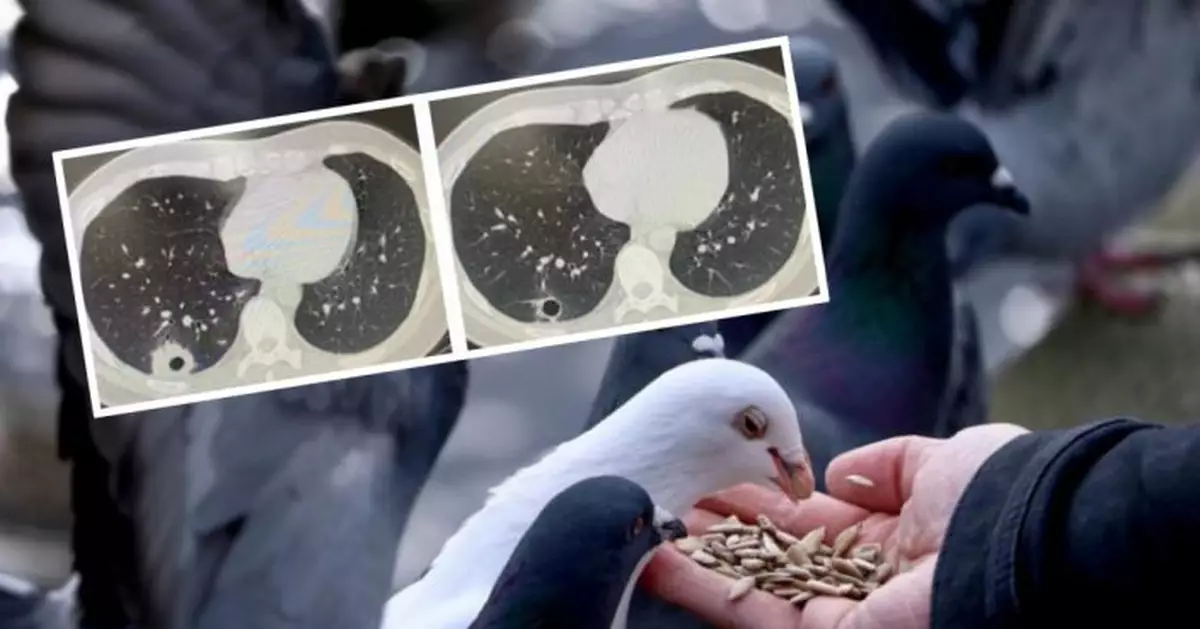 杭州男捉野鴿感染隱球菌莢膜 持續發燒咳嗽險喪命