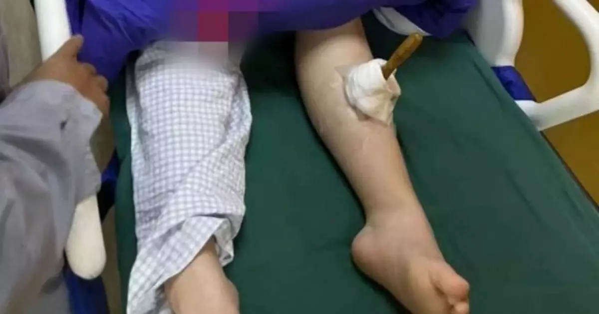 上海小學生勞作堂玩耍 遭同學鐵錐直插入小腿