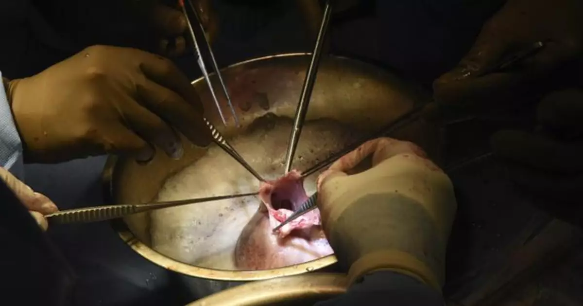 美國完成第2宗豬心臟移植人體手術 患者已能坐起開玩笑