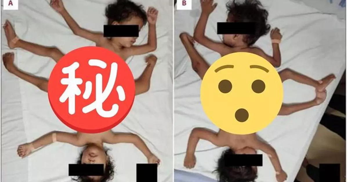 印尼「連體孖生兄弟」共用器官及3條腿似「蜘蛛」 3歲前無法起身！