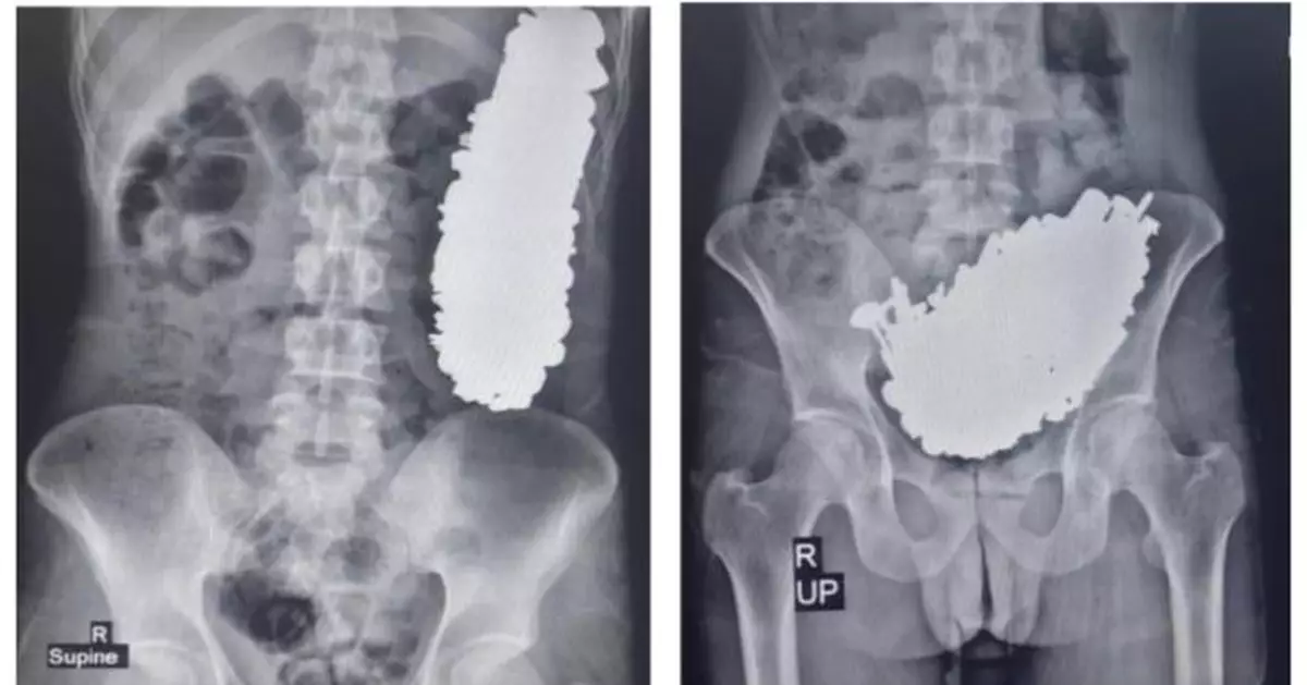 伊朗男腹痛求醫遭揭胃塞爆3公斤金屬零件 醫生推斷因患1病所致