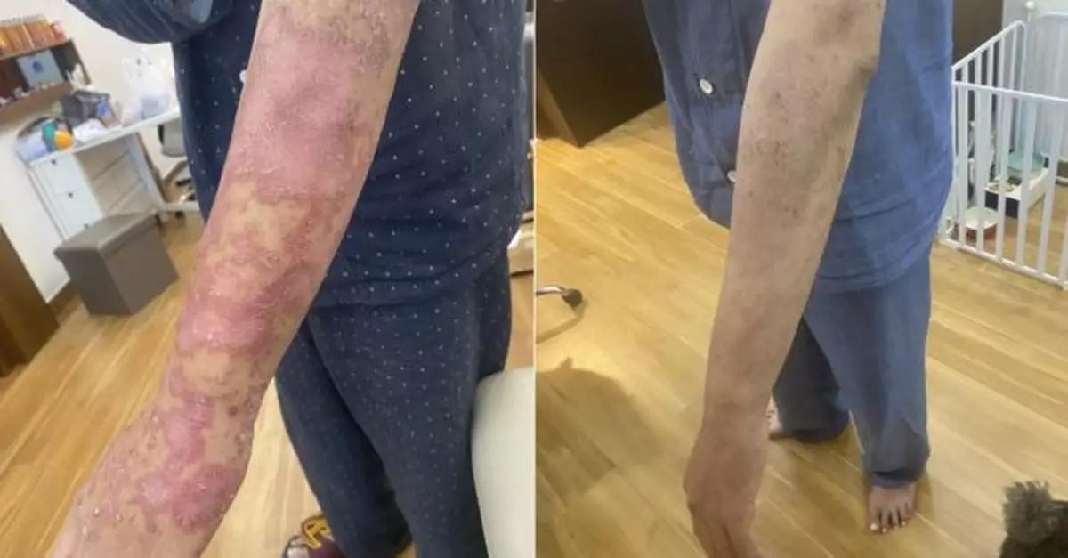 調查指約半數受訪銀屑病友因較便宜　曾於內地或計劃到內地打針