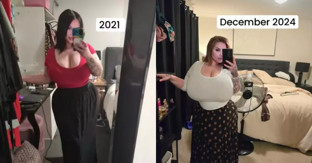 胸部不受控發育 澳女患「巨乳症」尺寸達驚人P罩杯需花數千定制內衣