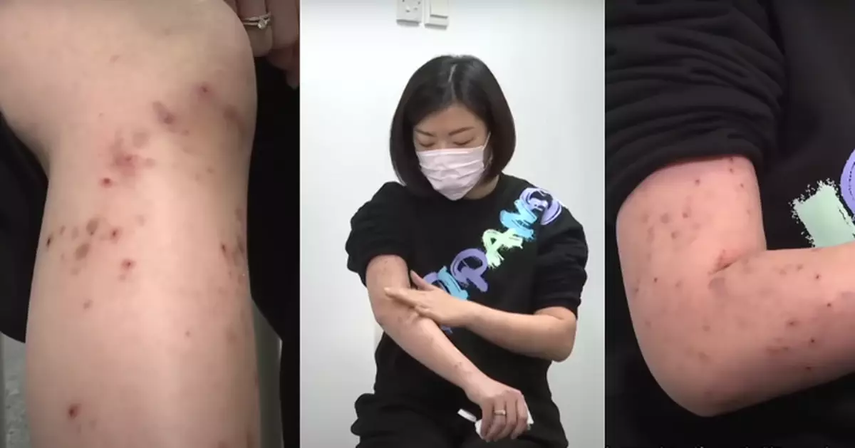 一線搜查｜濕疹成因多樣發作身心受影響 專家教：非要「斷尾」而是要「改善」