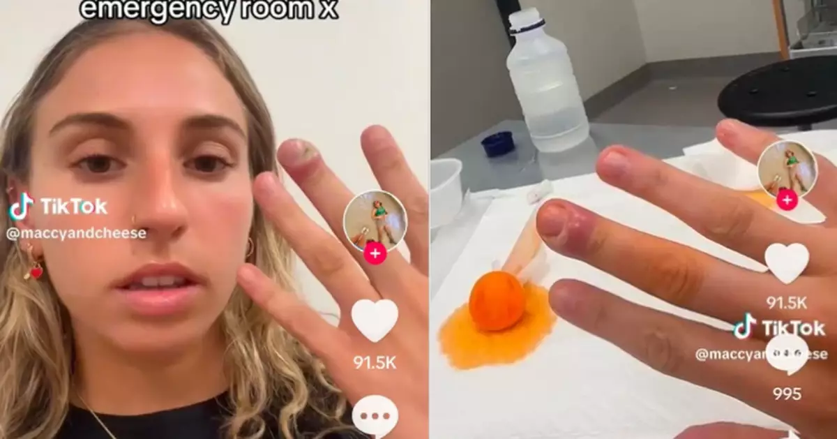 自幼愛摳指甲 澳女2度患「甲溝炎」手指化膿發臭就醫擠出2毫升膿液