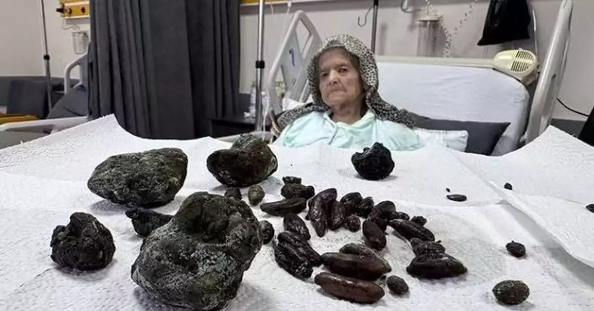 腹痛就醫揭腸道卡結石 土耳其9旬婦手術取出63粒核及5拳頭大結石