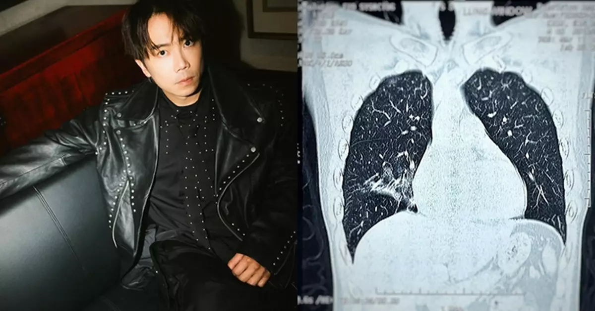 ToNick主音恆仔開騷期間患病咳嗽  貼X光照情況：個肺花咗少少