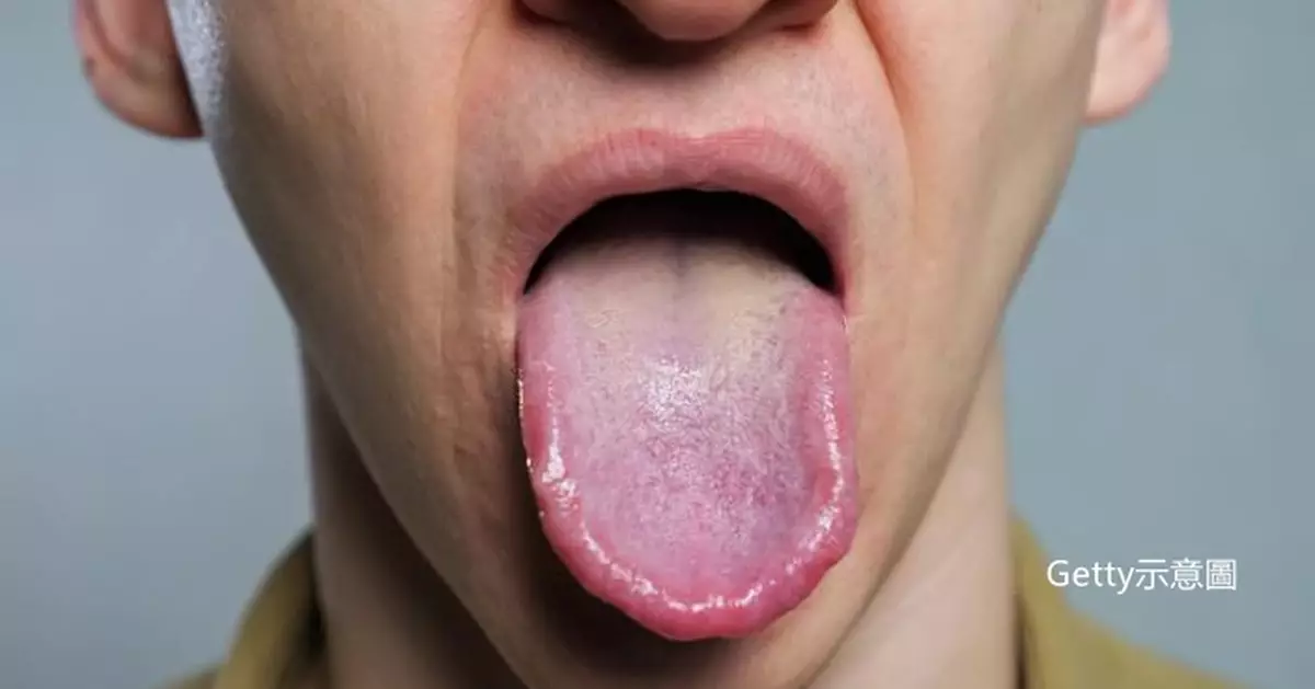 可能係健康警訊 日專家提醒：舌頭出現4大狀況需重視！