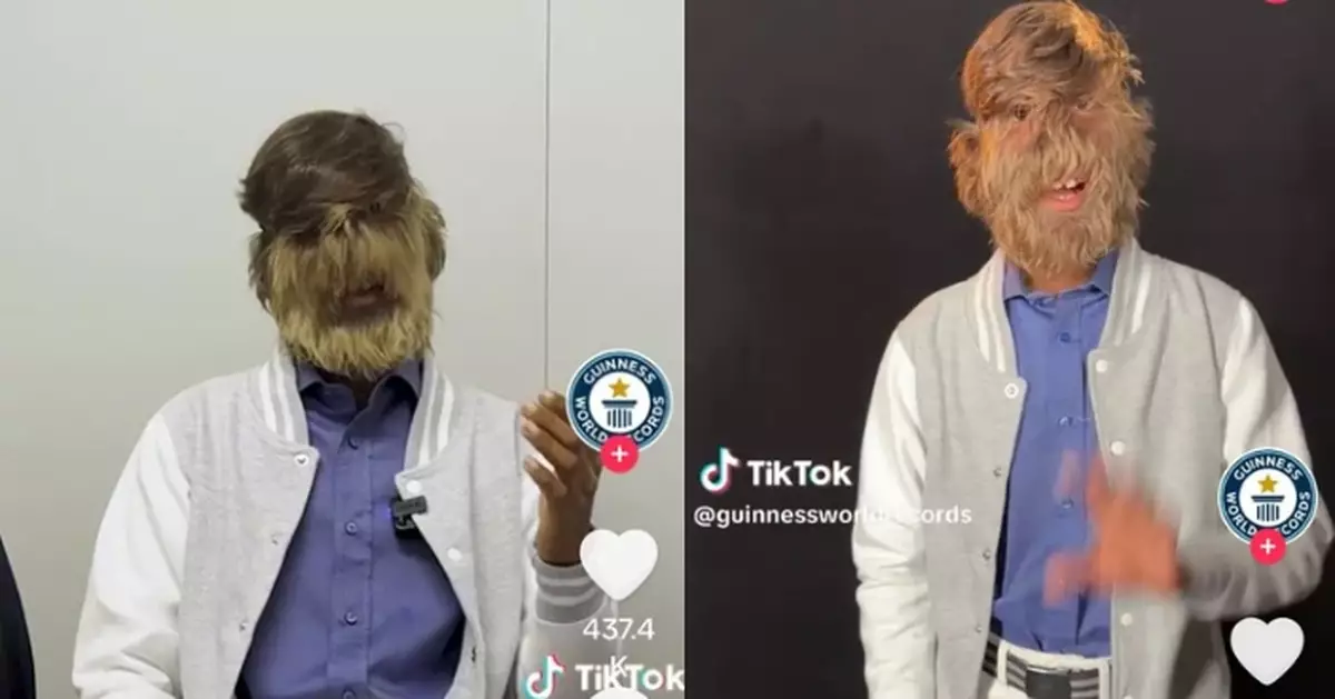 患超罕見多毛症 印度「狼人少年」獲健力士認證「臉部毛髮最濃密男性」