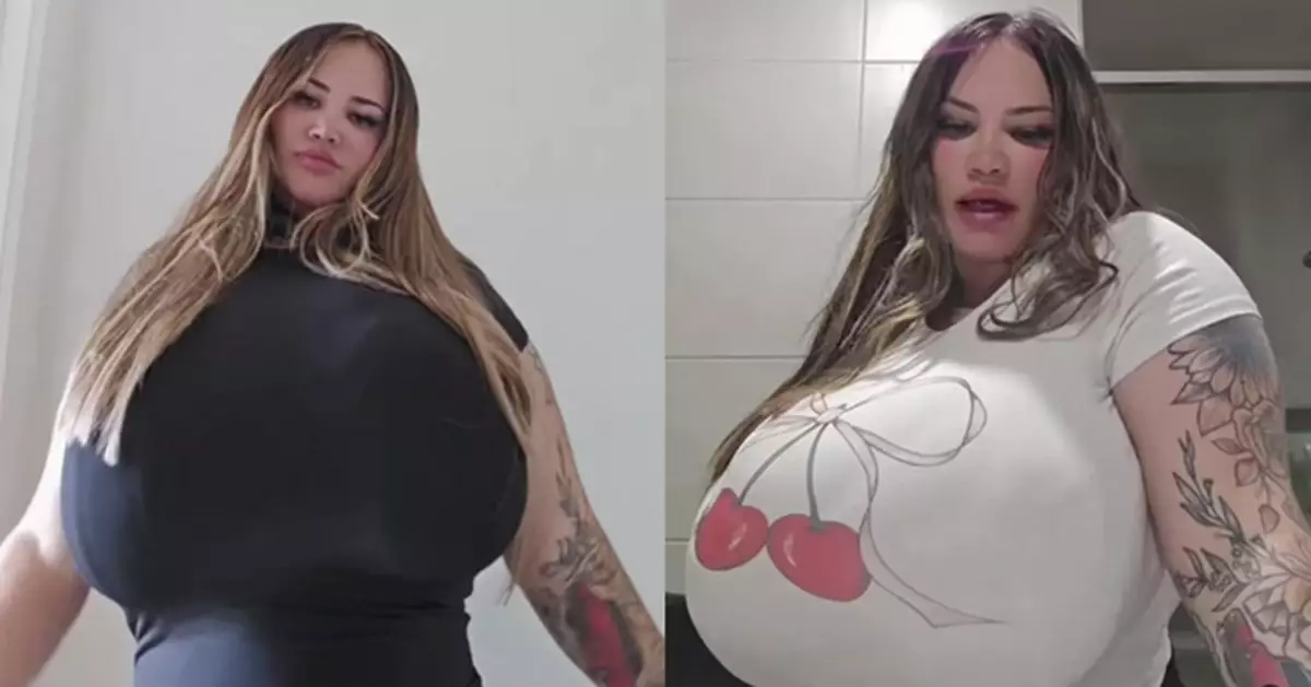 患罕見「巨乳症」胸部大過頭 澳女望做縮胸手術遭醫拒絕？