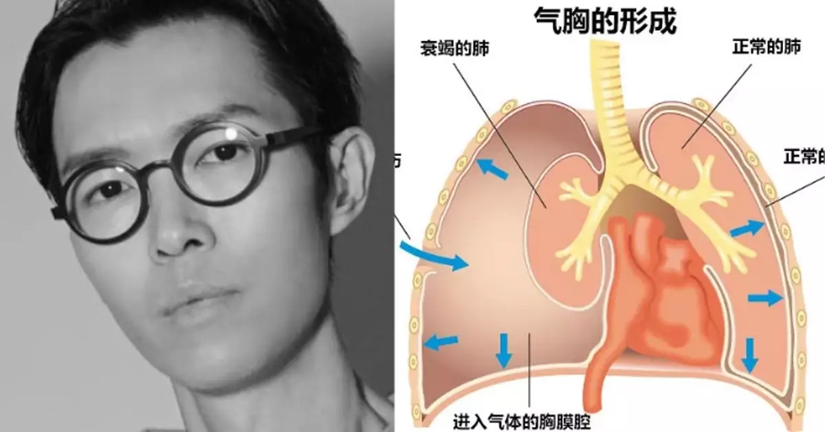 什麼是爆肺？方大同病逝前數次因「爆肺」入院　三類高發人群要注意！