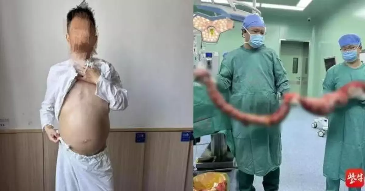 南京漢便秘4個月腹部腫脹如大肚婆  醫生開刀取出20斤「巨蟒」病腸