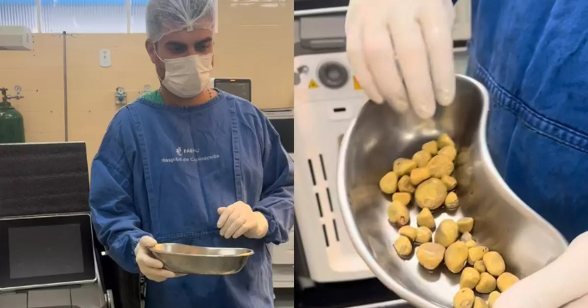 日飲3升可樂健康亮紅燈 巴西男病患就醫膀胱取出35顆「巨大結石」