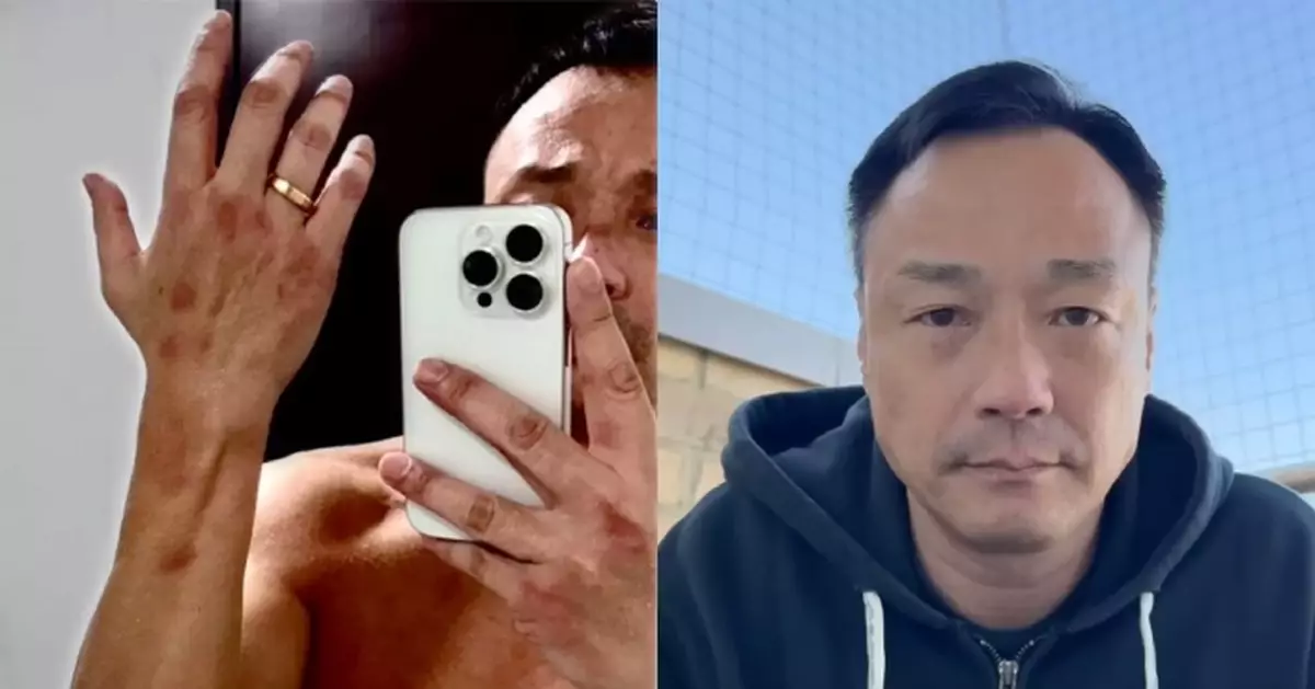 王喜自爆去年於台灣遭兩度迷姦 疑因此患橫紋肌肉溶解致急性腎衰竭