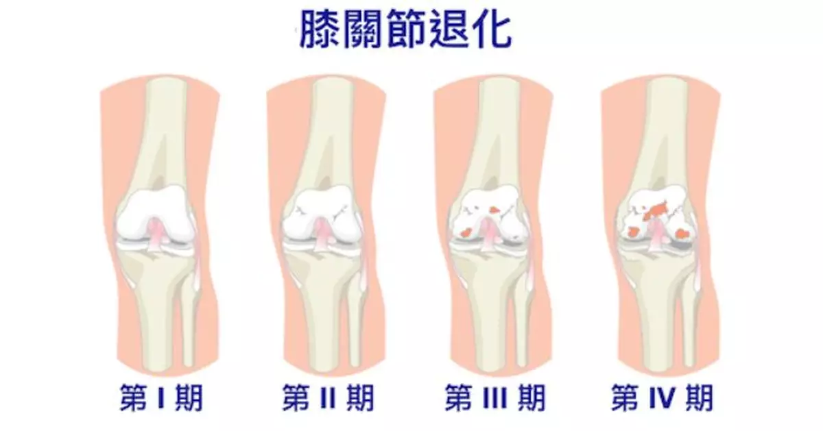 中西醫協作膝骨關節炎治療先導計劃 公院服務點增至5間