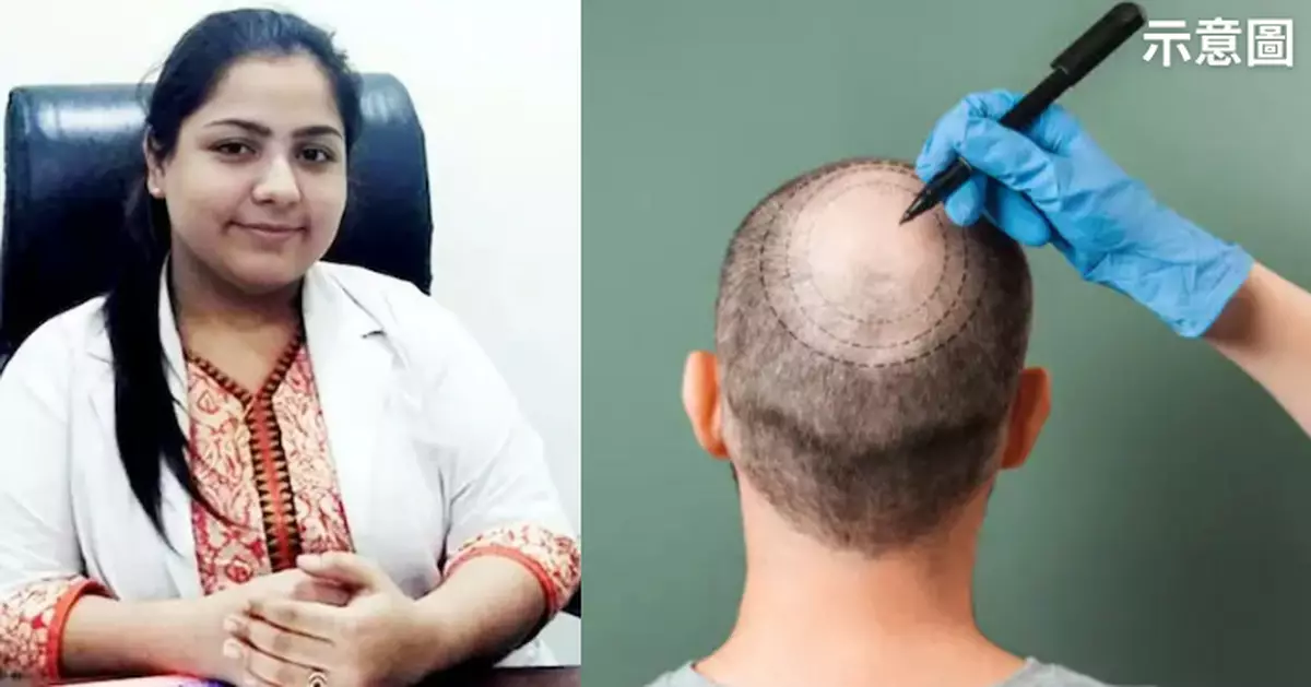 印度無牌女醫植髮害命 2工程師術後48小時內相繼身亡