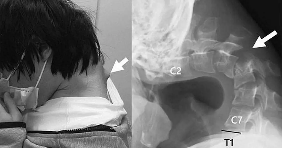 長期低頭打手遊 日本25歲男頸部長角患「垂頭症」需手術改善