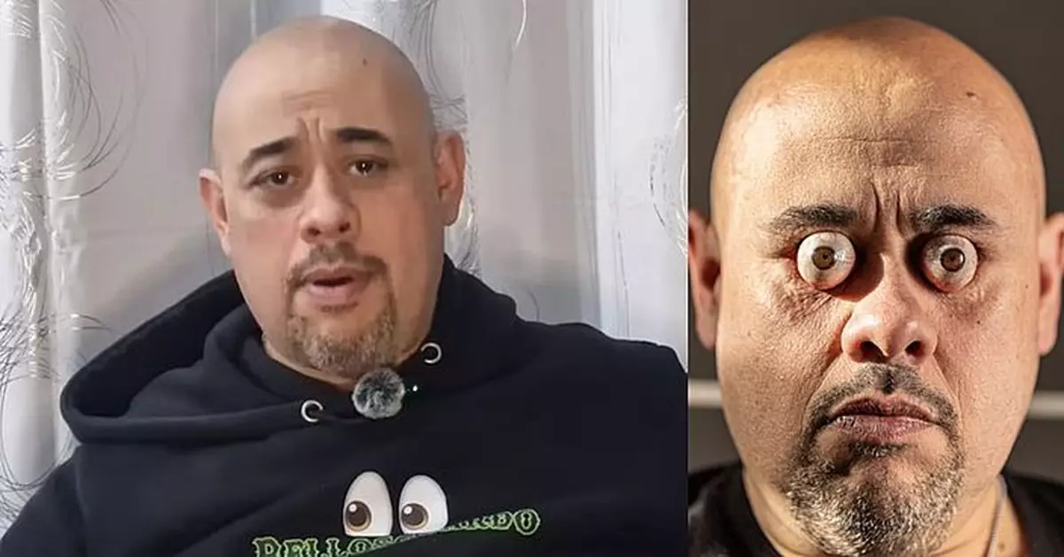 慎入！烏拉圭男天生異稟 能將眼珠彈出眼窩1.88厘米創世界紀錄