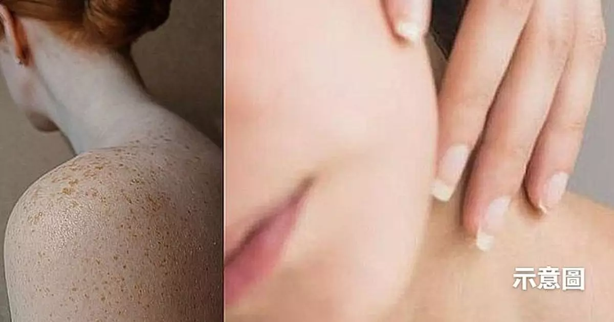 飲食也能淡斑？台灣營養師推介9大營養素助抗黑色素養成「白皙肌膚」