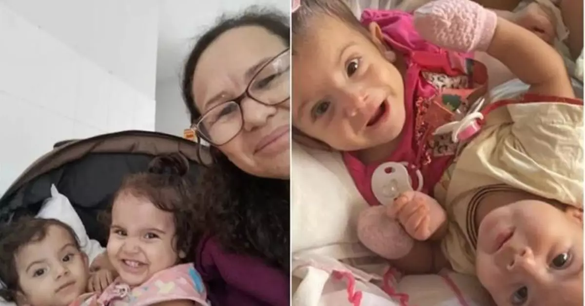 罕見病例！巴西1歲連體嬰成功分離 60醫護奮戰15小時創生命奇蹟