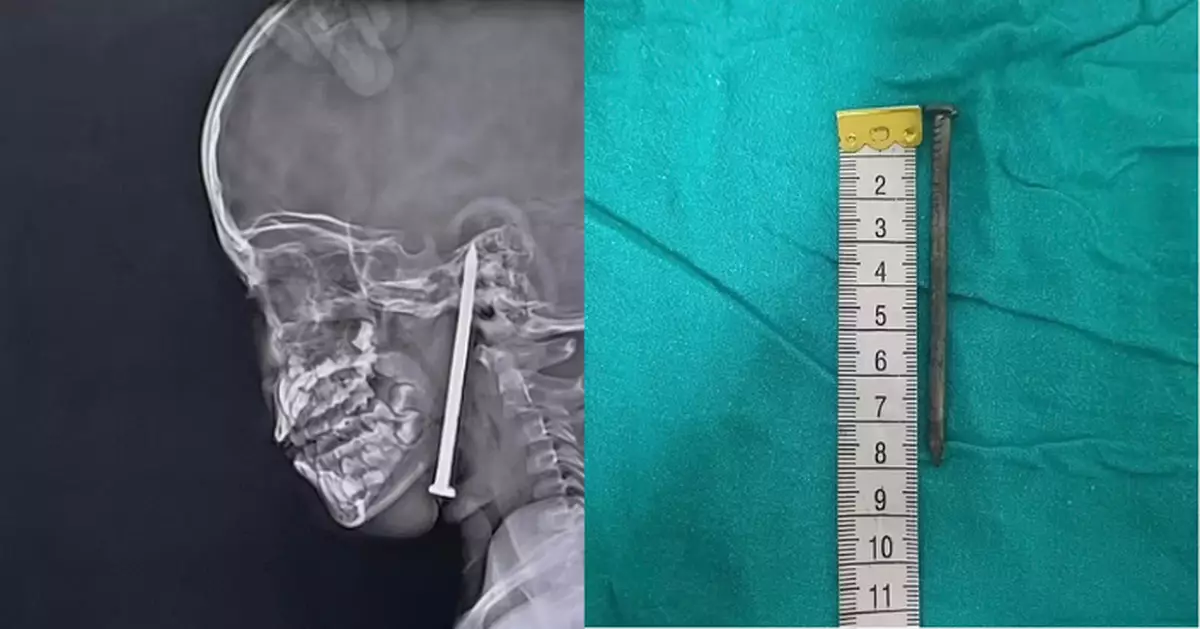 跌倒遭8CM鐵釘直插入腦 印度男童歷10小時手術奇蹟保命