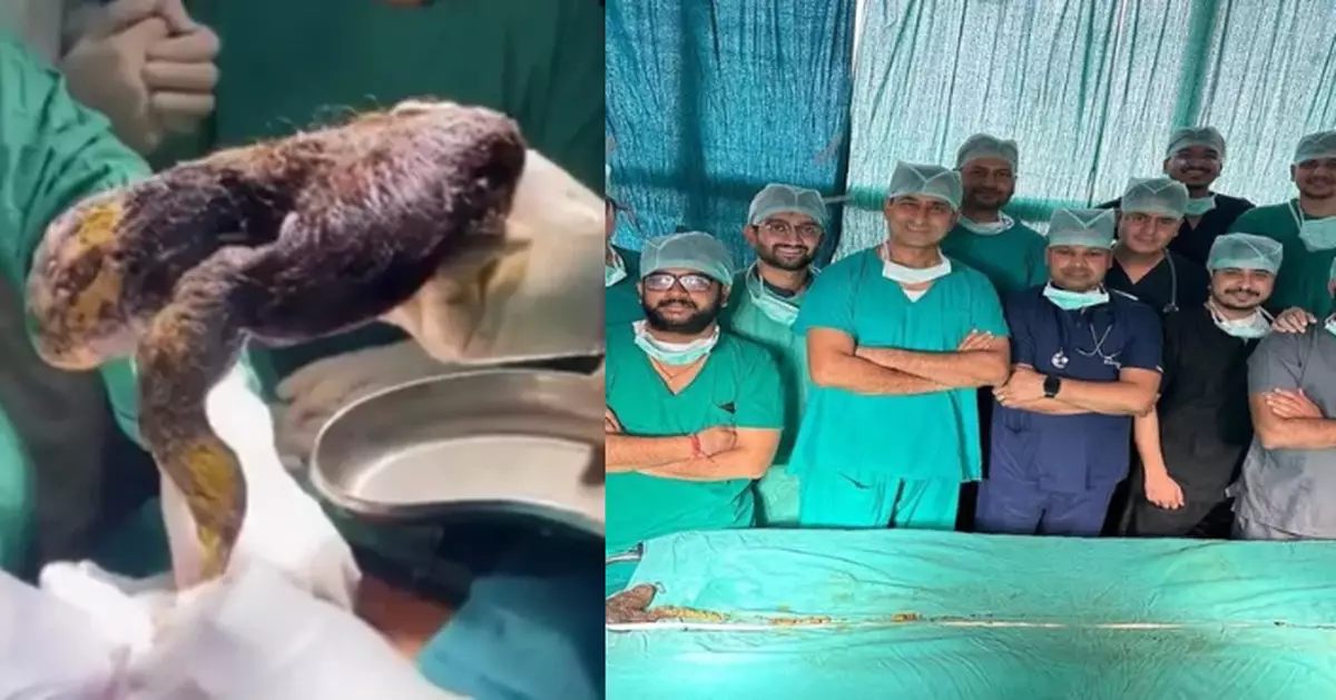 印度少女長期飽受腹痛困擾就醫 醫生拉出210CM毛球或破世界紀錄