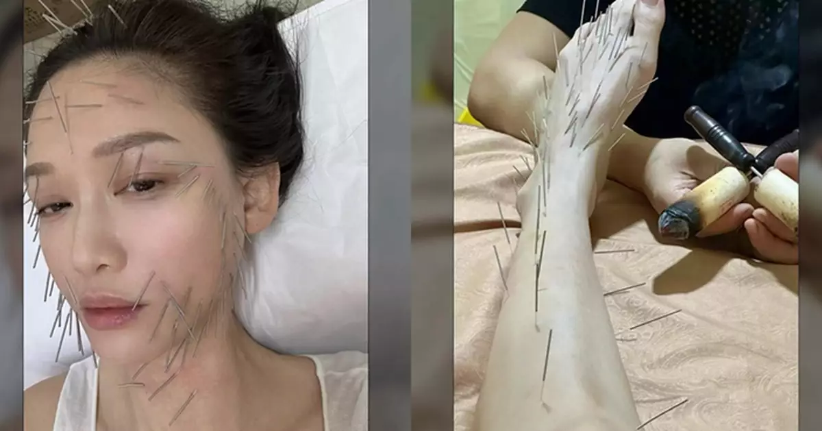 陳喬恩「針雕」地獄式減肥  化身「人體針插板」千針插滿全身痛到飆淚