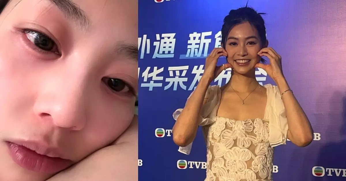 TVB大灣區影視發布會｜郭柏妍食物敏感後首現身 詳述當日情況坦言曾擔心到喊