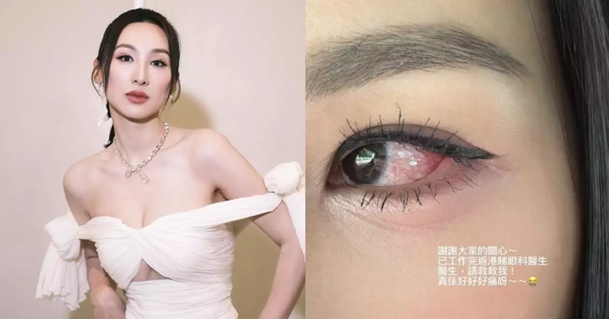 高海寧左眼眼疾變嚴重 完Job急趕回港求醫接受治療