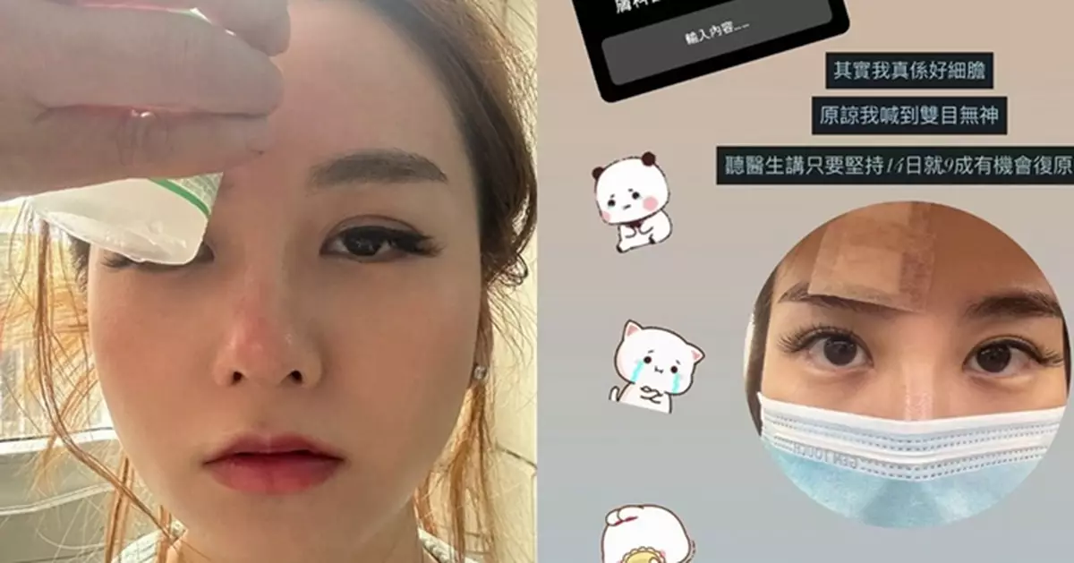 「威龍潘金蓮」梁茵慘遭電髮棒燙傷險毀容！ 150度高溫灼面 額頭鼻樑紅腫脫皮