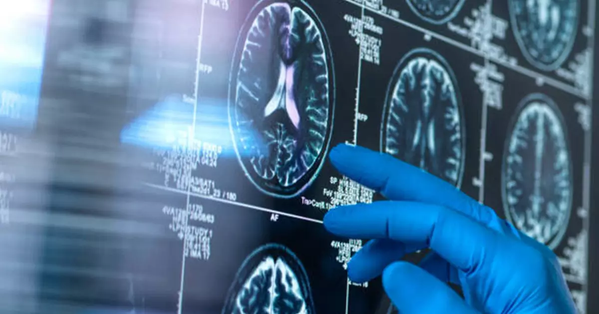 腦部受傷犯罪機率大增？哈佛研究指「這部位」是關鍵