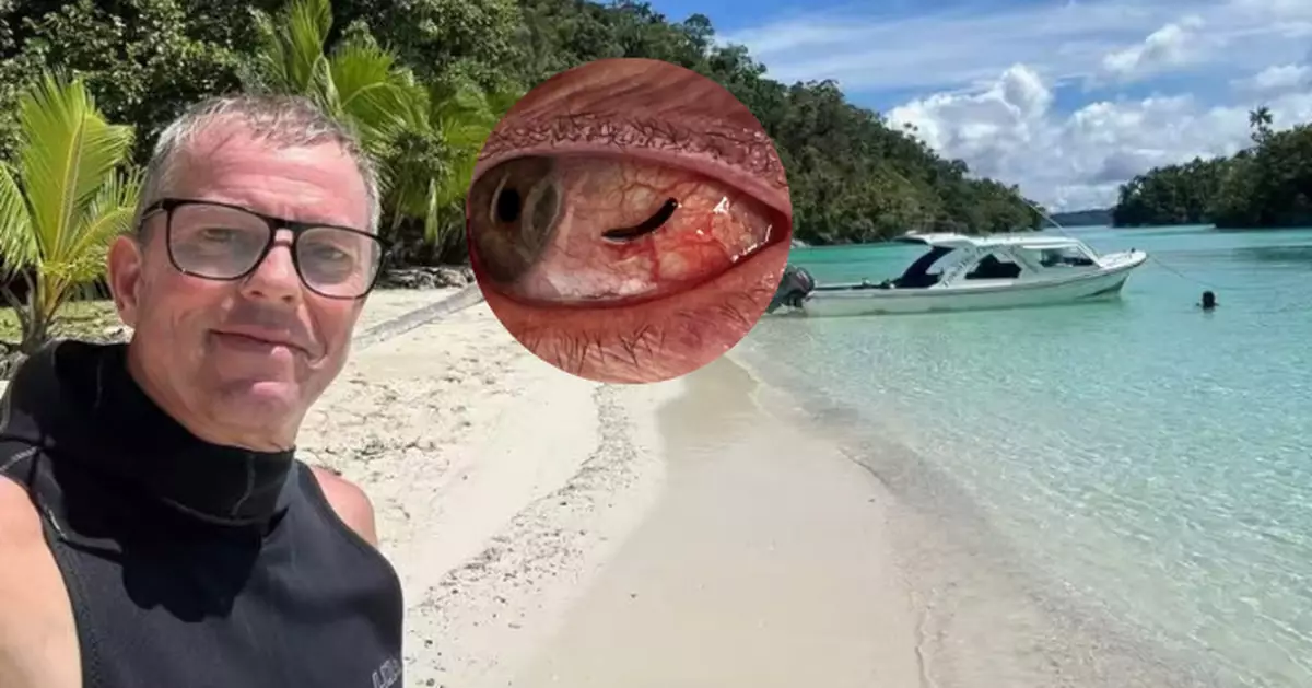 慎入！英男印尼拍鳥遭水蛭吸附眼白6小時 獲醫生用鉗取出痛呻：像拽眼珠