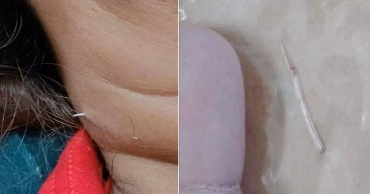 泰婦誤吞魚刺鯁喉 兩週後竟「穿透皮膚」從頸部露出 需手術取出