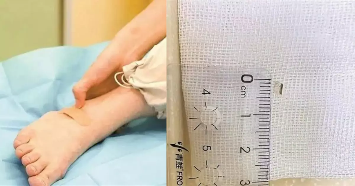 右腳背持續腫痛未癒 深圳女難忍求醫驚揭4MM玻璃碎「潛伏」8年