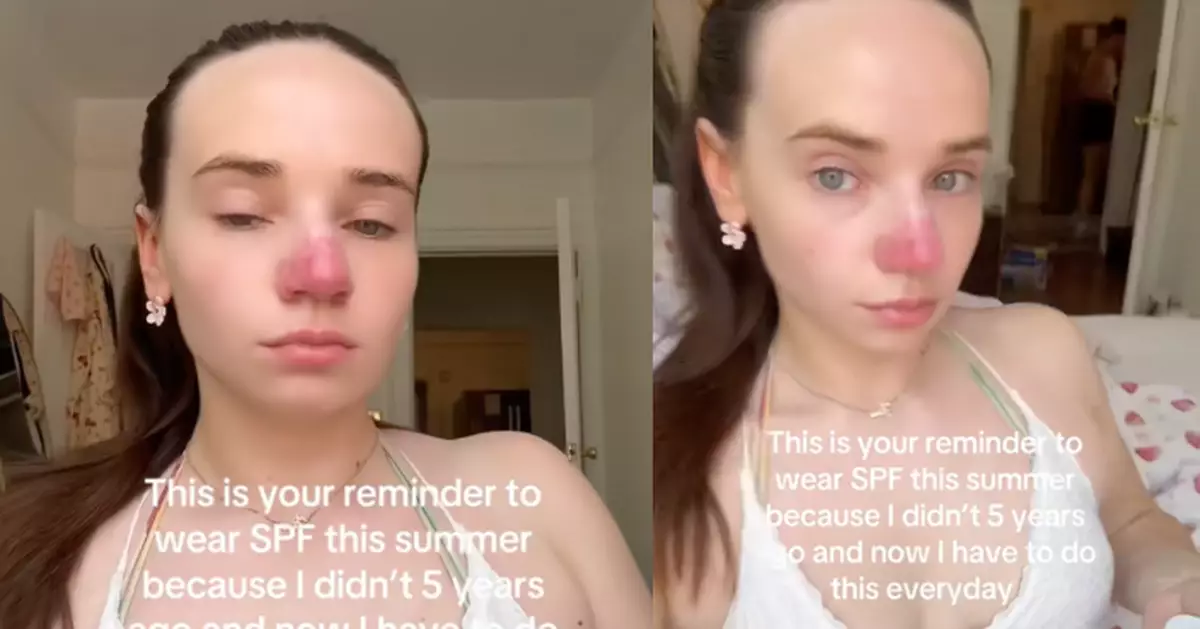 烈日下未塗防曬瞓4小時 愛爾蘭女鼻子曬傷變「酒糟鼻」5年仍未癒