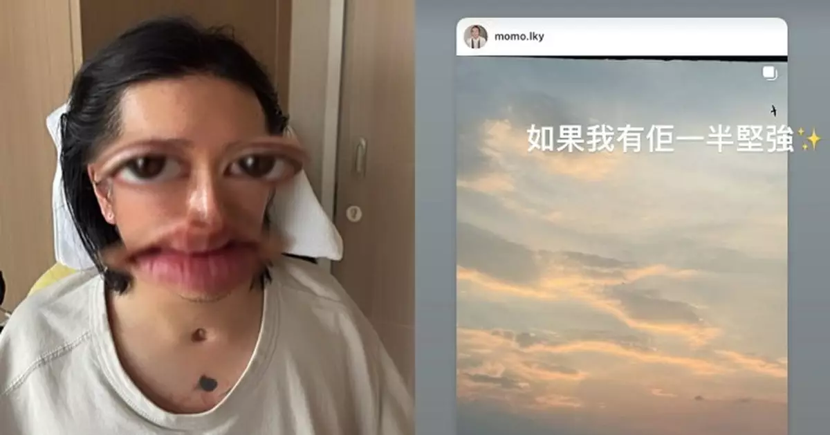 阿Mo首晒自拍露出「呼吸道造口」SoChing心疼：如果我有佢一半堅強