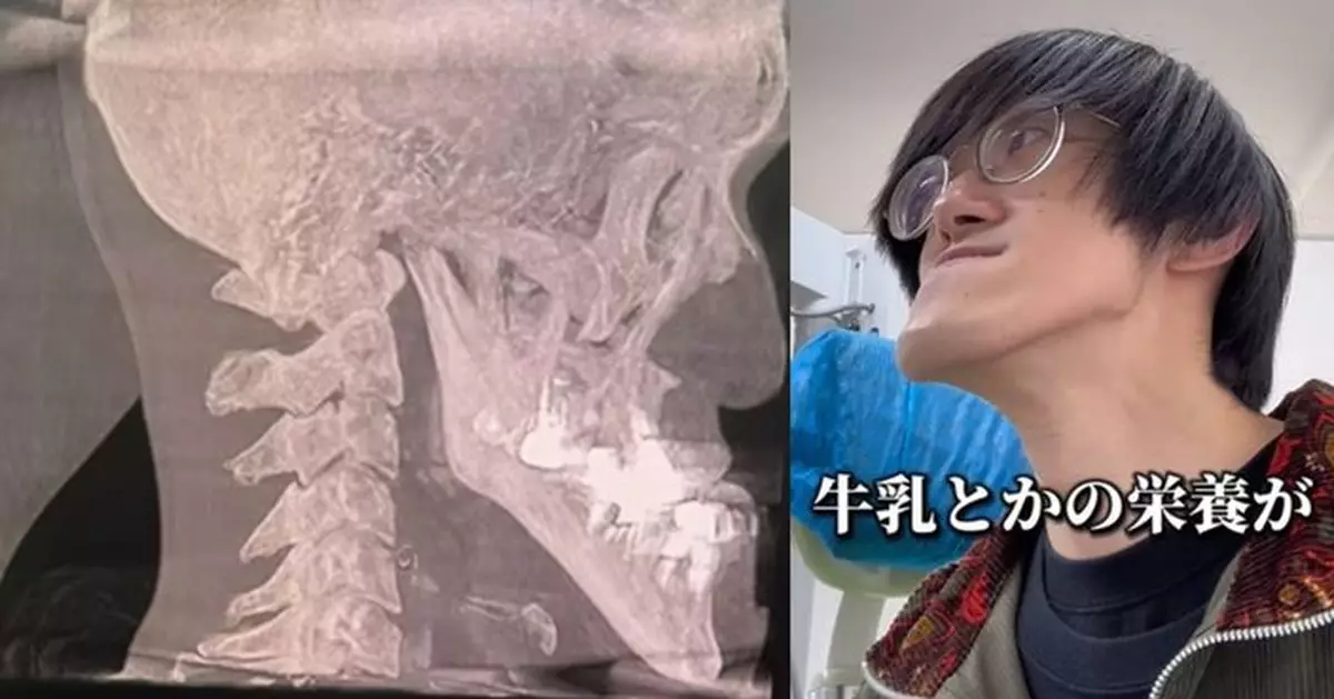 世界第一長！日男長「鞋抽下巴」照X光 醫生驚叫骨骼精奇前所未見