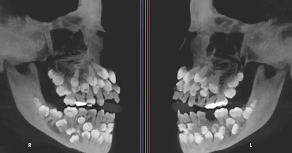 巴西11歲女童口腔藏81顆牙！X光驚見「牙齒礦場」 醫：正常應僅32顆