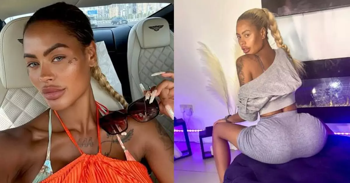 貪平赴異國豐臀  英女模深蹲植入物突「脫落」無奈再花67萬修復