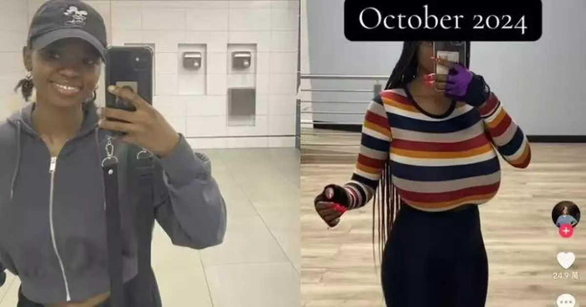 南非女患「巨乳症」胸部數月暴增5罩杯重到行路吃力 眾籌做縮胸手術