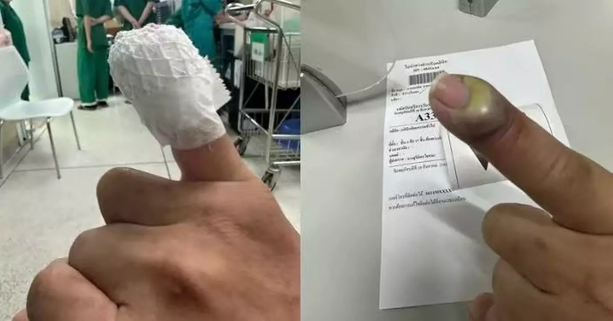 被貓抓傷冇理會 泰寵物美容師手指嚴重感染化膿險需截肢